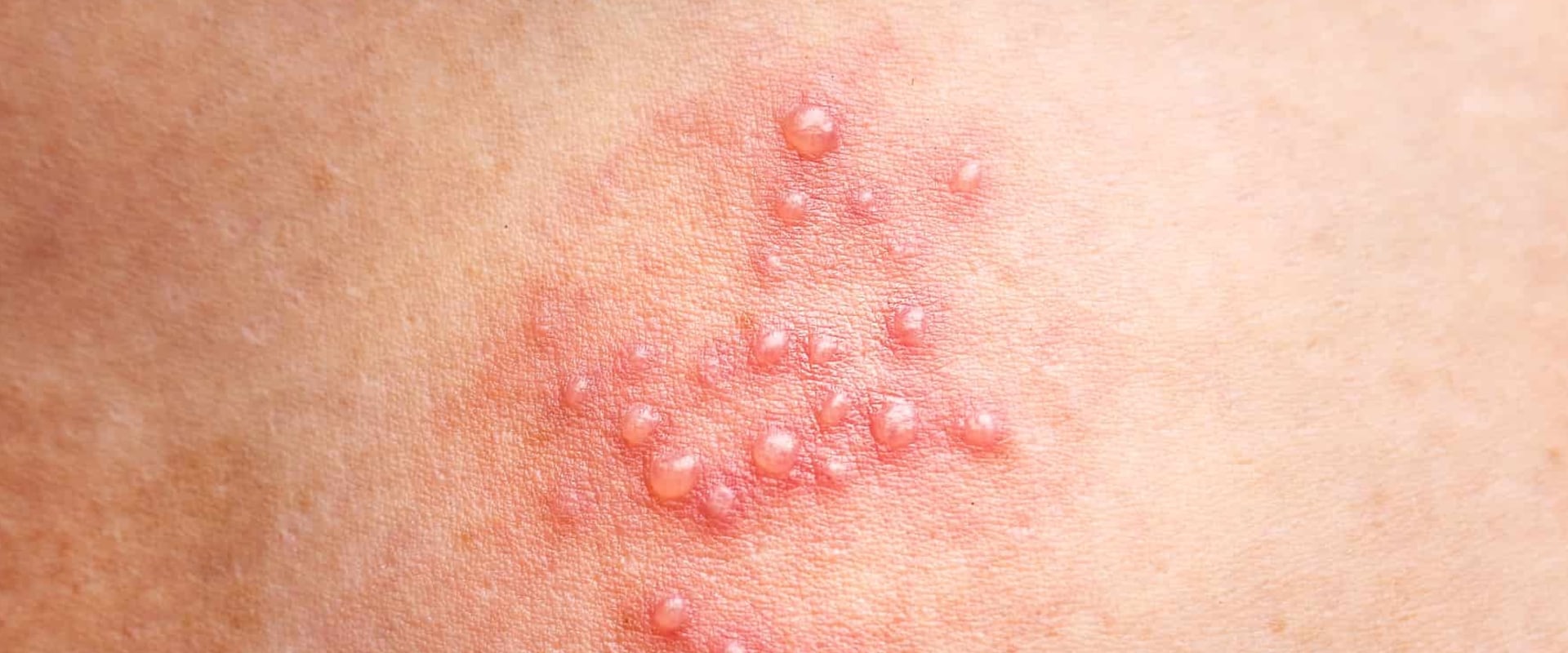 The Basics of Genital Sores or Rashes
