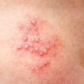 The Basics of Genital Sores or Rashes