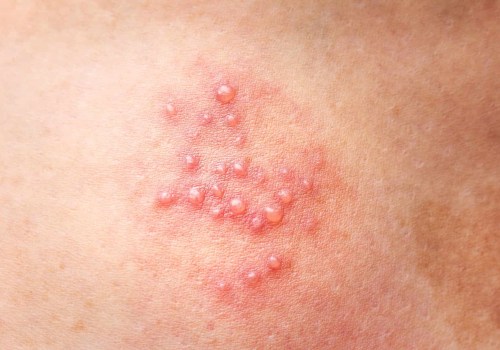 The Basics of Genital Sores or Rashes